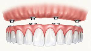 Exploring the Benefits of Dental Implants in Rockville